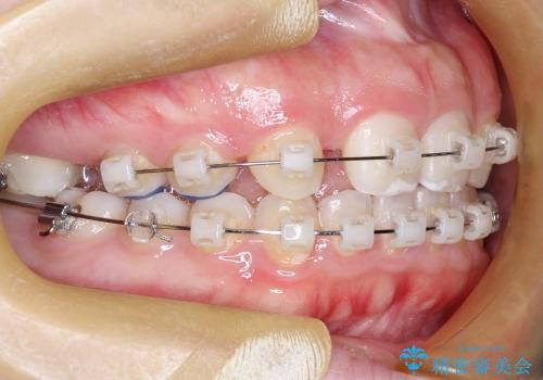 20代女性 奥歯の部分矯正の一例の治療前