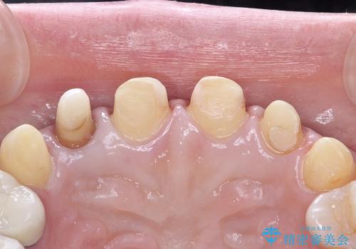 20代女性 前歯の部分矯正(extrusion)の治療後