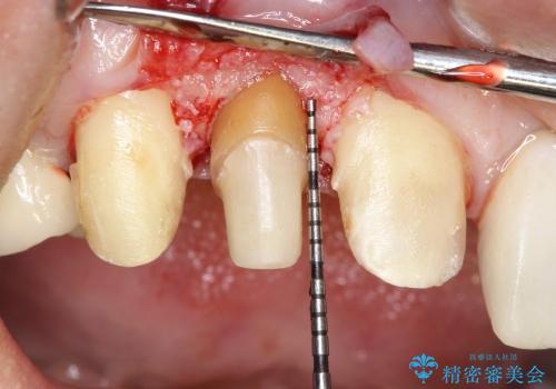 20代女性 前歯の部分矯正(extrusion)の治療中