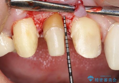 20代女性 前歯の部分矯正+オールセラミックの治療中