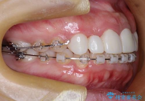 20代女性 奥歯の部分矯正の一例の治療後