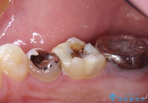 30代男性 奥歯の虫歯治療→セラミックによる修復の治療前
