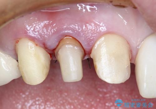 20代女性 前歯の部分矯正(extrusion)の治療中