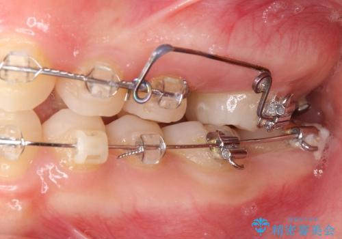 20代女性 奥歯の部分矯正の一例の治療中