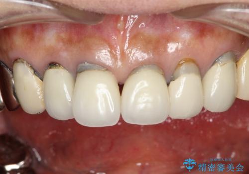 前歯7本のオールセラミック(50代女性)の治療前