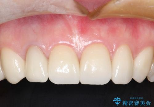20代女性 前歯の部分矯正+オールセラミックの治療後