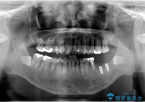 奥歯3本のインプラント治療(50代 男性)の治療中