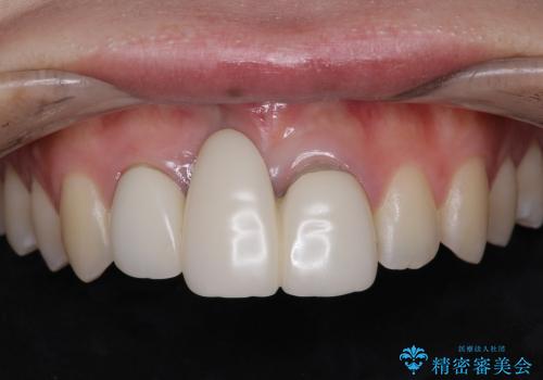 歯ぐきの状態を改善した,前歯ブリッジの再作製の治療前
