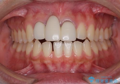 歯ぐきの状態を改善した,前歯ブリッジの再作製の治療前