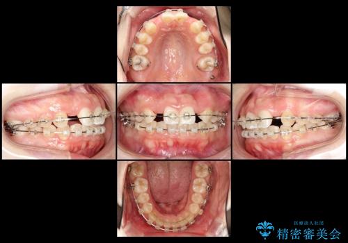 20代女性 奥歯の部分矯正の一例の治療中