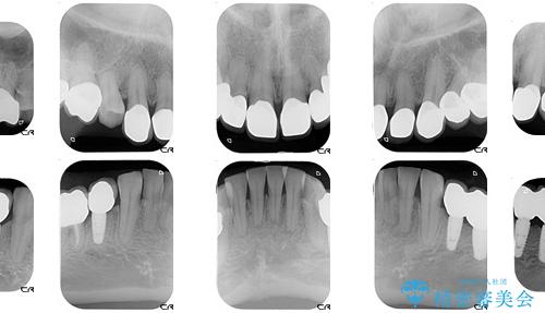30代女性　虫歯が多くて人前で口を開けられない　審美歯科治療の治療後