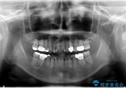 臼歯部メタルフリー治療の治療後