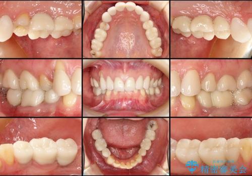 30代女性　虫歯が多くて人前で口を開けられない　審美歯科治療の治療後