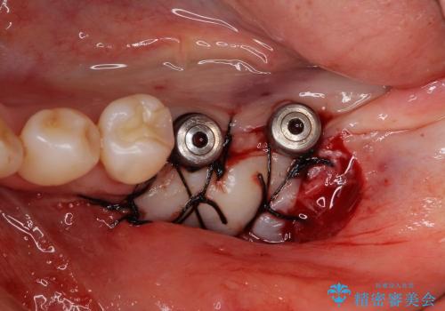 骨がない場合のインプラント治療③ (インプラント周囲に歯肉移植の治療中