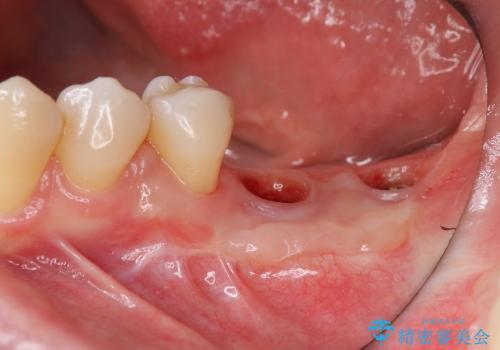 骨がない場合のインプラント治療③ (インプラント周囲に歯肉移植の治療後
