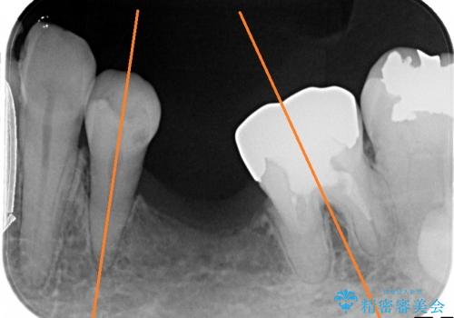 50代女性 傾いた奥歯の部分矯正による整直の治療前