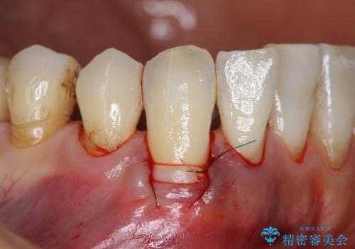 前歯の歯ぐき再生治療の治療中