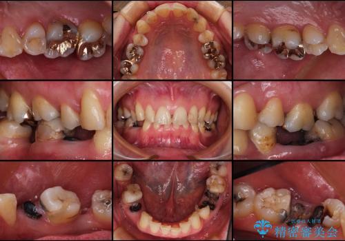 30代女性　虫歯が多くて人前で口を開けられない　審美歯科治療の治療前