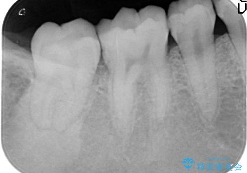 20代女性 奥歯の痛み→根管治療・被せものの治療前