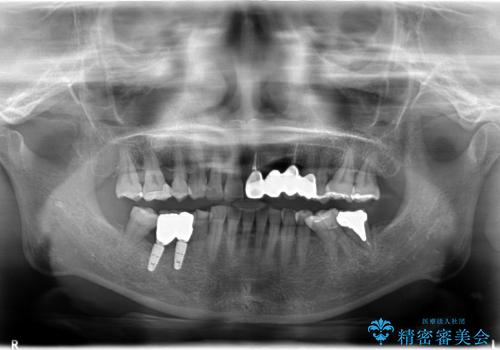 40代女性 歯周外科・インプラントを含んだメタルフリー治療の治療後
