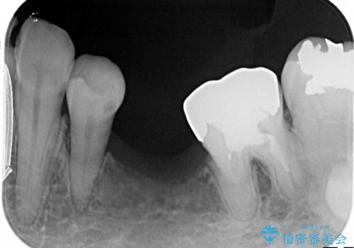 50代女性 傾いた奥歯の部分矯正による整直の治療前