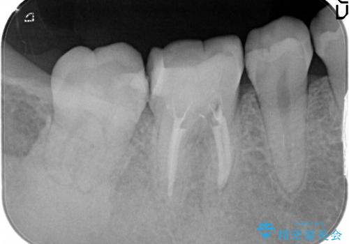 20代女性 奥歯の痛み→根管治療・被せものの治療中