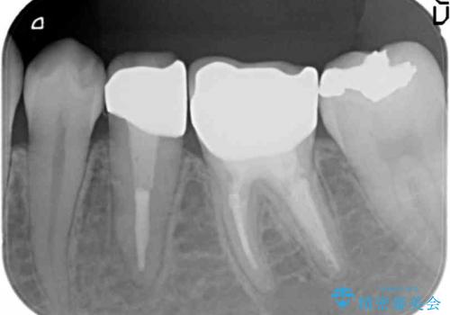 深い虫歯の治療　20代男性の治療後