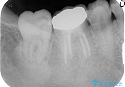 20代女性 奥歯の痛み→根管治療・被せものの治療後