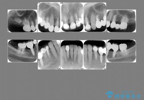 前歯のセラミック、奥歯のインプラントの治療後