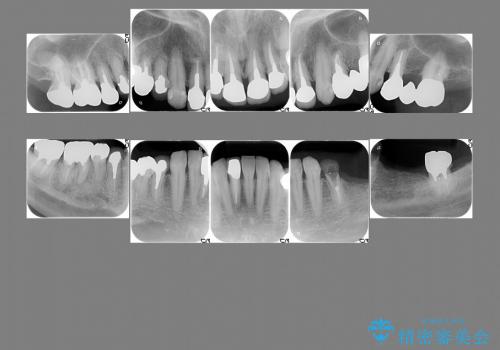 前歯のセラミック、奥歯のインプラントの治療前