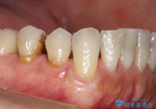 前歯の歯ぐき再生治療の治療後