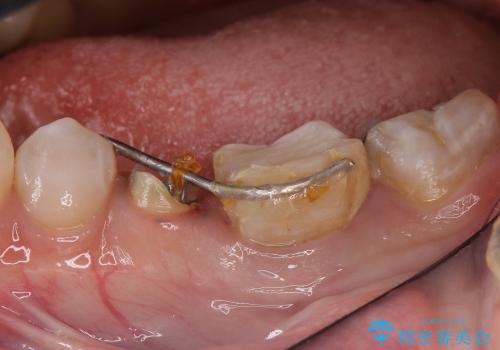 深い虫歯の治療　20代男性の治療前