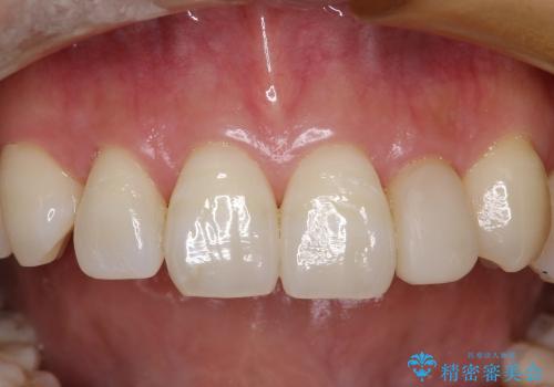 前歯の矮小歯のセラミックでの治療の治療前