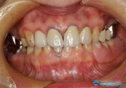 前歯のセラミック、奥歯のインプラントの治療前