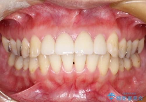 20代女性 プラスチックにより継ぎ接ぎ状態となった前歯を綺麗にの症例 治療後