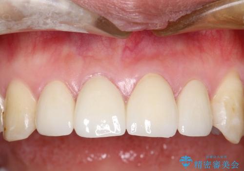 20代女性 プラスチックにより継ぎ接ぎ状態となった前歯を綺麗にの治療後
