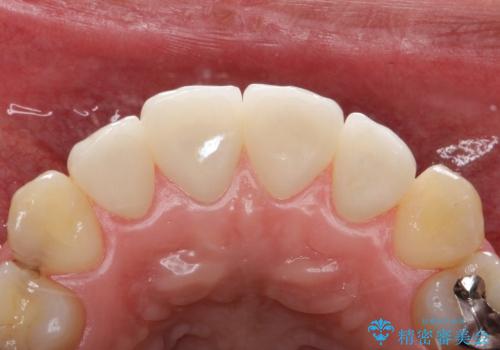 20代女性 プラスチックにより継ぎ接ぎ状態となった前歯を綺麗にの治療後