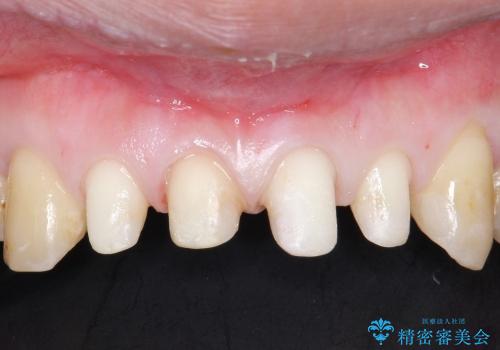 20代女性 プラスチックにより継ぎ接ぎ状態となった前歯を綺麗にの治療中