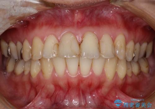 20代女性 プラスチックにより継ぎ接ぎ状態となった前歯を綺麗にの治療前
