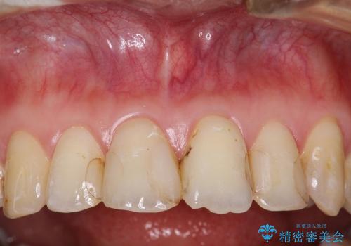 20代女性 プラスチックにより継ぎ接ぎ状態となった前歯を綺麗にの治療前