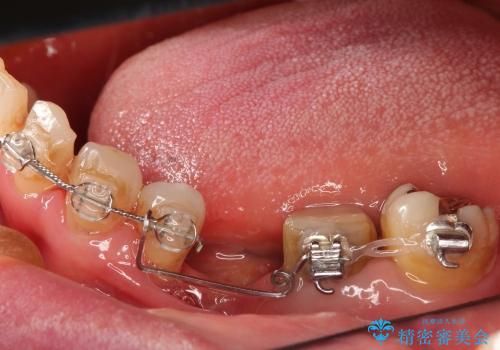 50代女性 傾いた奥歯の部分矯正による整直の治療中