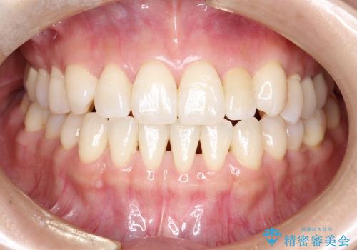 前歯の矮小歯のセラミックでの治療の治療後