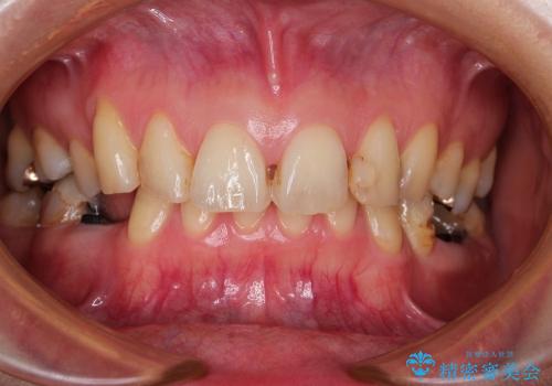30代女性　虫歯が多くて人前で口を開けられない　審美歯科治療