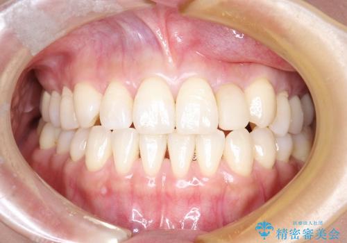 前歯の矮小歯のセラミックでの治療の治療前