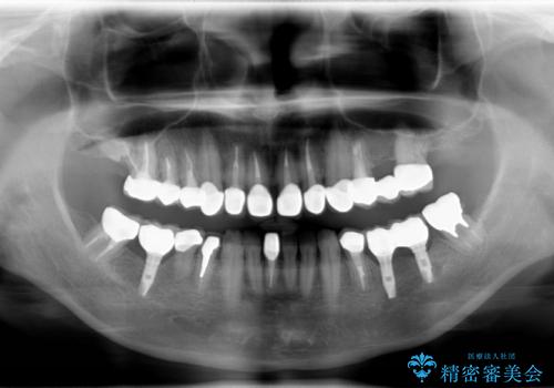 前歯のセラミック、奥歯のインプラントの治療後