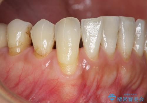 前歯の歯ぐき再生治療の治療前