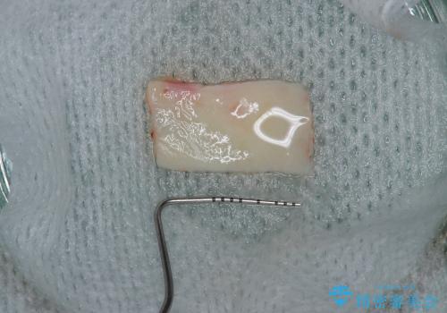 骨がない場合のインプラント治療③ (インプラント周囲に歯肉移植の治療中