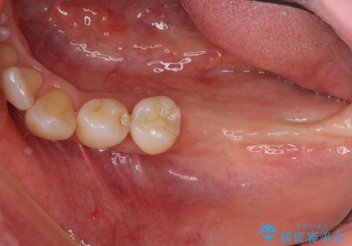 骨がない場合のインプラント治療③ (インプラント周囲に歯肉移植の治療前