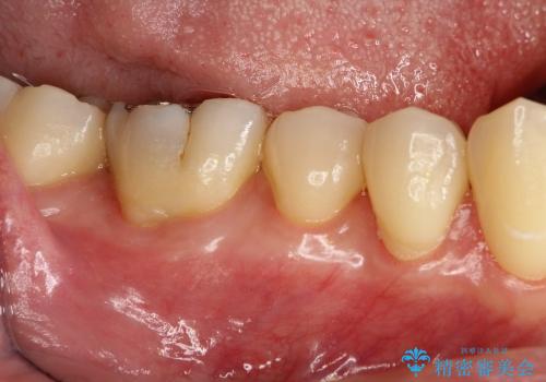下がりにくい歯ぐきをつくる(はぐきの移植)の症例 治療前