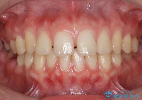 前歯のすき歯　シザーズバイトの症例 治療前